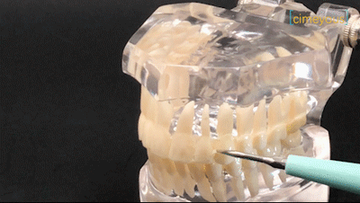 DreamVeneers Ultrasonic Plaque & Stain Remover (Dental Scaler)